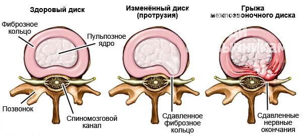 Остеохондроз 2 степени с частыми обострениями армия Остеохондроз 2 степени с частыми обострениями армия