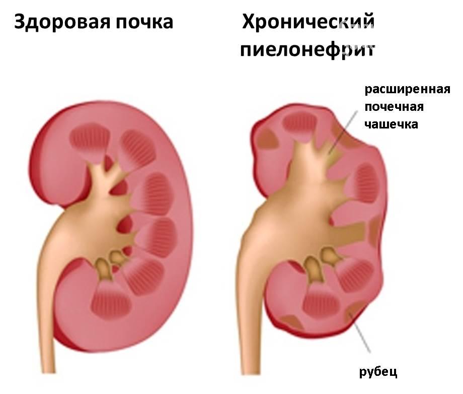 Берут ли в армию с хроническим пиелонефритом?