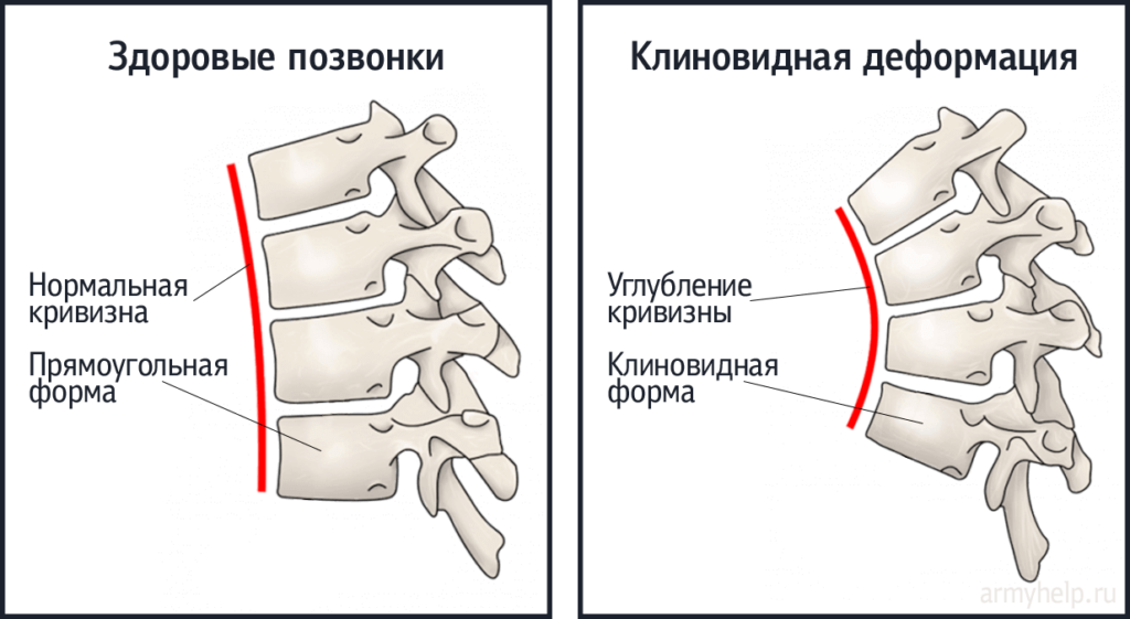 Деформация позвонков. Берут ли в армию с искривлением позвоночника. Остеохондропатический кифоз с углом деформации. Остеохондропатический кифоз с углом деформации превышающим 70. Остеохондропатический кифоз 70 градусов.