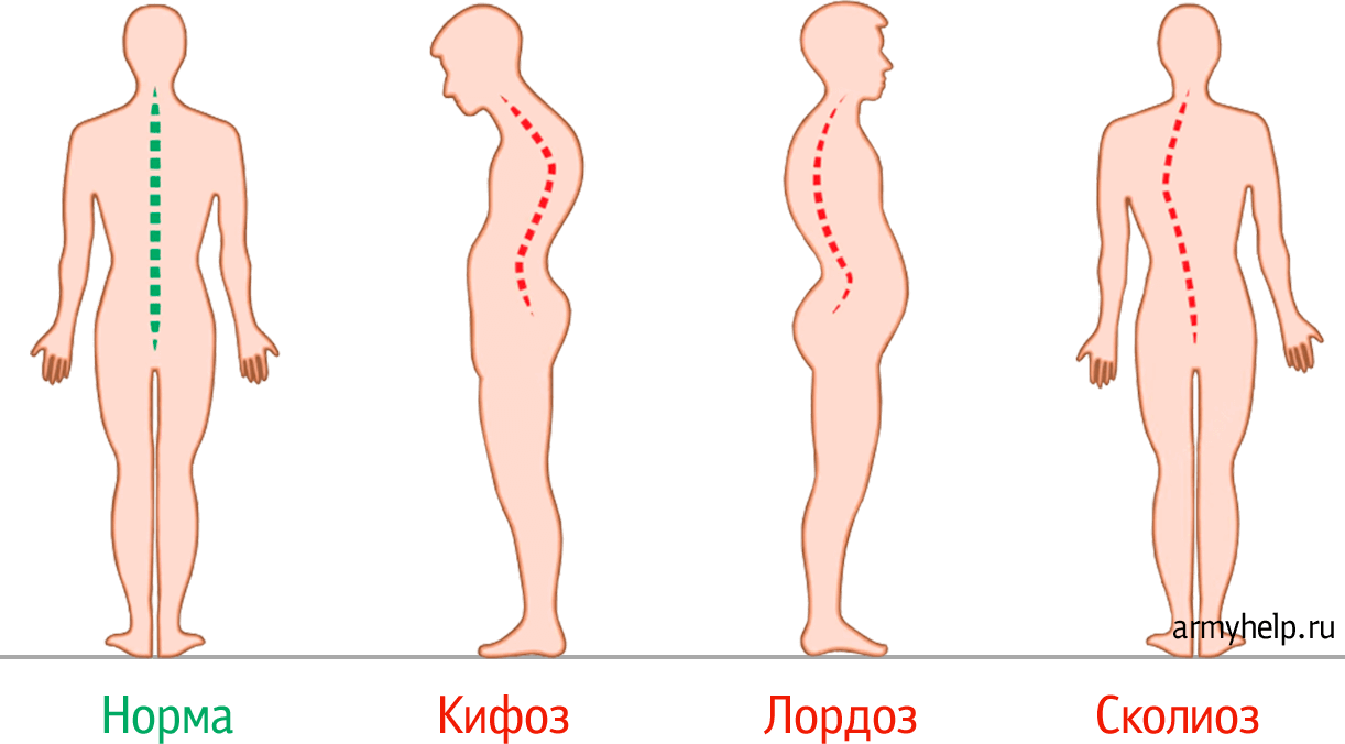 Плоскостопие и сколиоз берут ли. Кифоз сколиоз лордоз вектор. Типы искривления позвоночника. Искривление позвоночника 17 градусов. Кифоз сколиоз позвоночника.