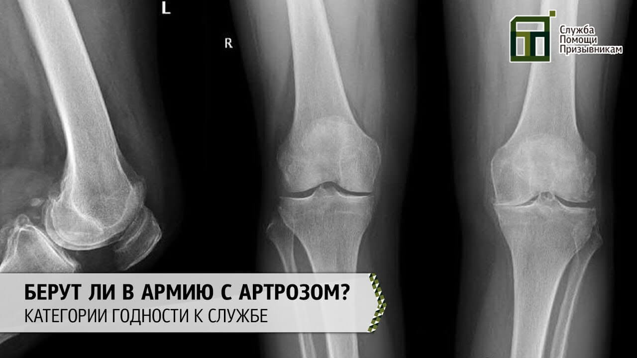 Берут ли в армию с артрозом