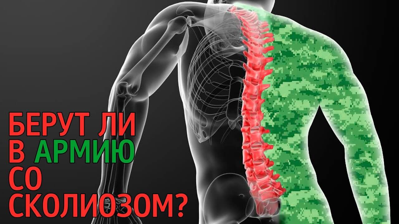 Берут ли в армию со сколиозом