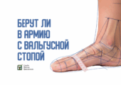 О том, как вальгусная стопа влияет на призыв в армию, мы рассказали здесь