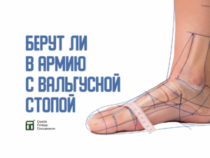 Берут ли в армию с вальгусной стопой